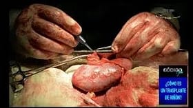 Resultado de imagen de imagenes transplante de riñon