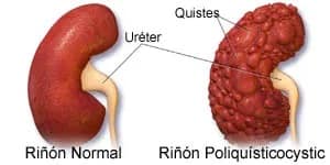 Poliquistosis_renal.jpg